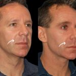 sculptra  in dubai