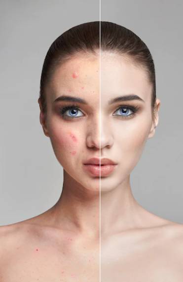 How Can You Prepare Your Skin Before Acne Scar Treatment in Dubai