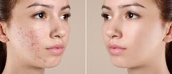How do I maintain results after acne scar treatment in Dubai