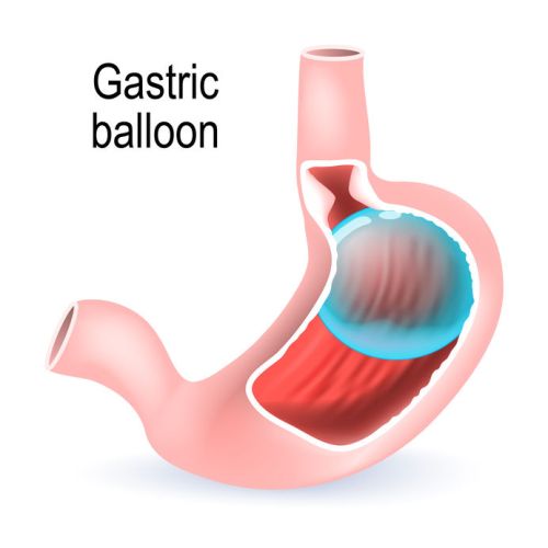 How do doctors determine the best gastric balloon size for patients in Dubai