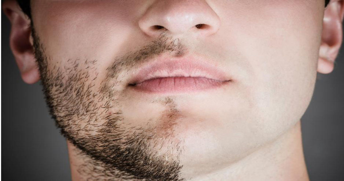 Laser-Hair-Removal-Face-Men_f20cd6cd-27bf-4544-bc21-2b01a28ea5c9 (1)
