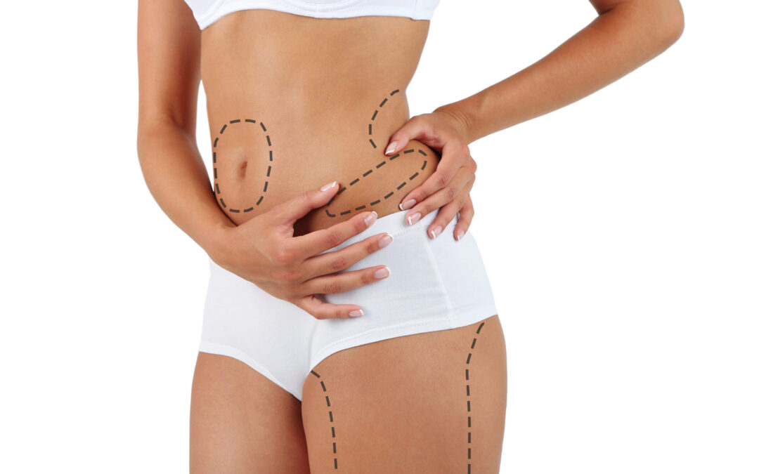 Liposuction cost in Riyadh