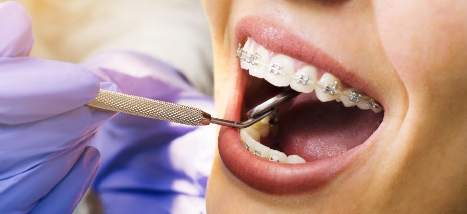 Orthodontic Treatment Types, Process & Benefits