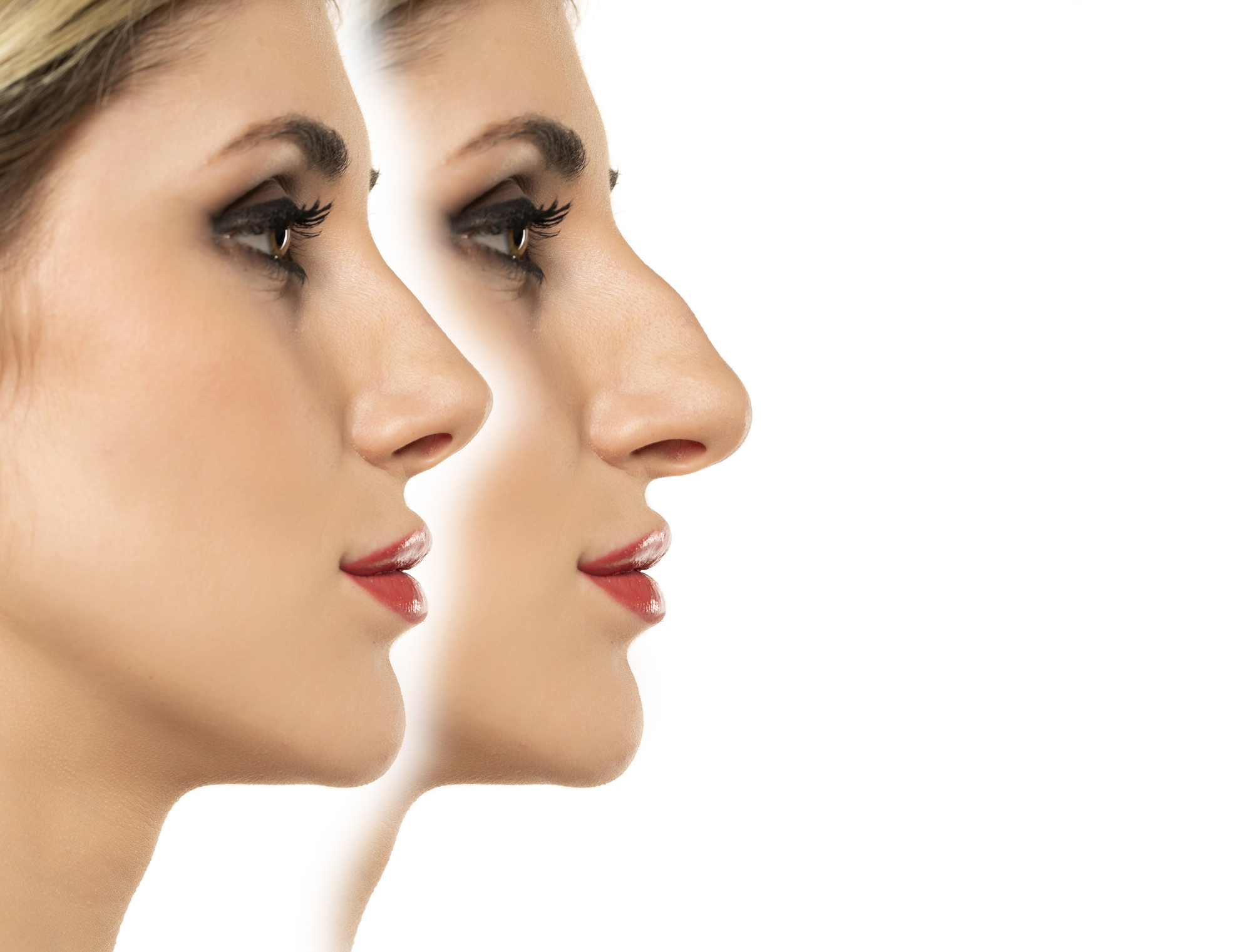 Rhinoplasty in Dubai 4