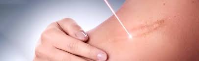 Scar Removal in Dubai 1