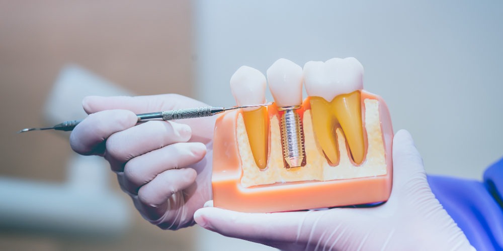 Specialists in Gum Health And Dental Implants