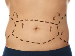 Tummy Tuck Dubai 3
