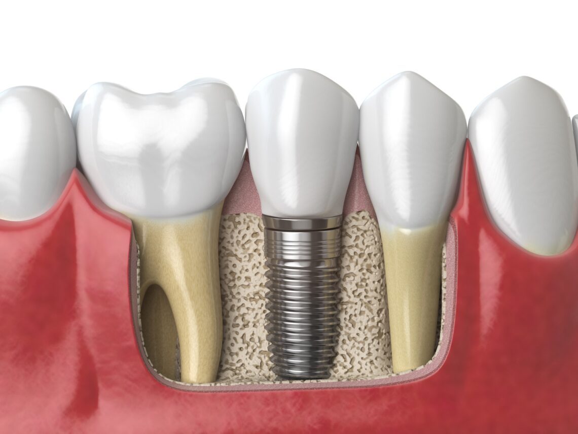 What Steps Are Involved in Placing a Dental Implant Safely?