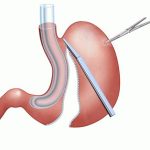 bariatric surgery in islamabad