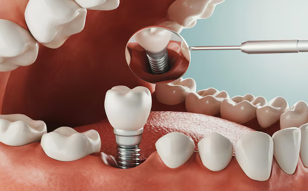 dental implants near bowling green ky
