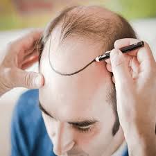 hair transplantation in Dubai (زراعة شعر في دبي