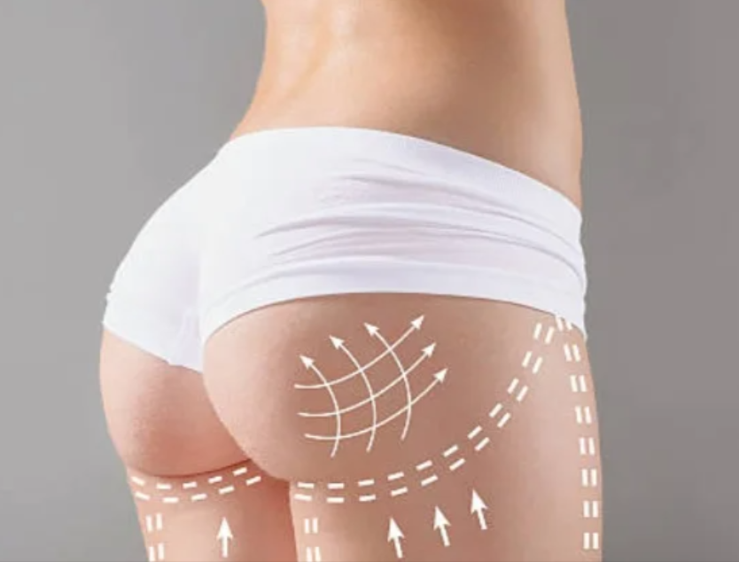 liposuction