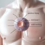 testicular cancer treatment image