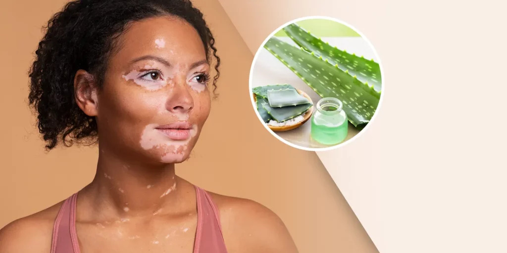 u10398-Vitiligo-Treatment-1024x512-1