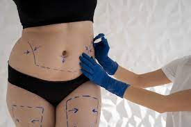 u2814-Are-there-alternatives-to-laser-liposuction-in-Dubai-for-fat-reduction