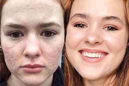 u2814-Can-acne-scar-treatment-in-Dubai-improve-overall-skin-tone-and-elasticity