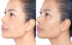 u2814-What-questions-should-you-ask-your-dermatologist-before-starting-pigmentation-treatment-in-Dubai