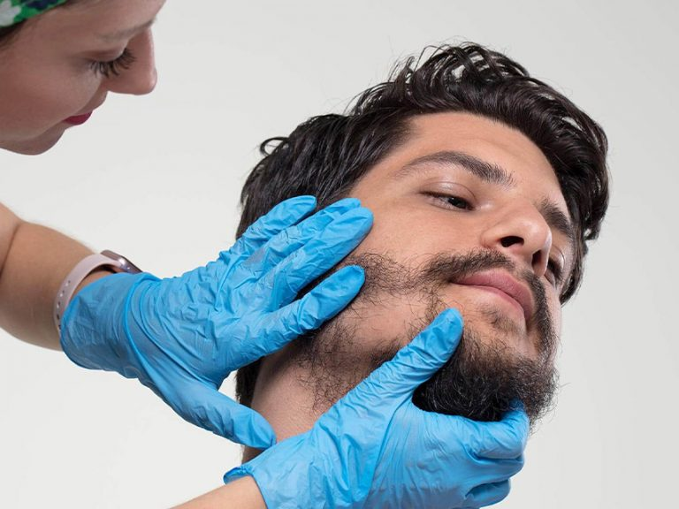 u2996-Beard-hair-transplant-in-Islamabad