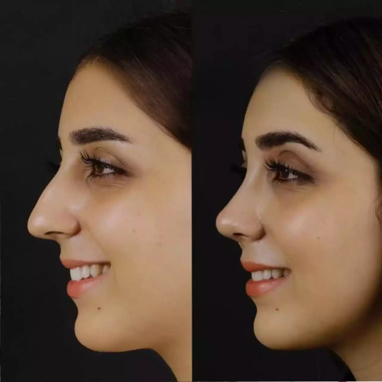 u3080-H-Rhinoplasty4-copy