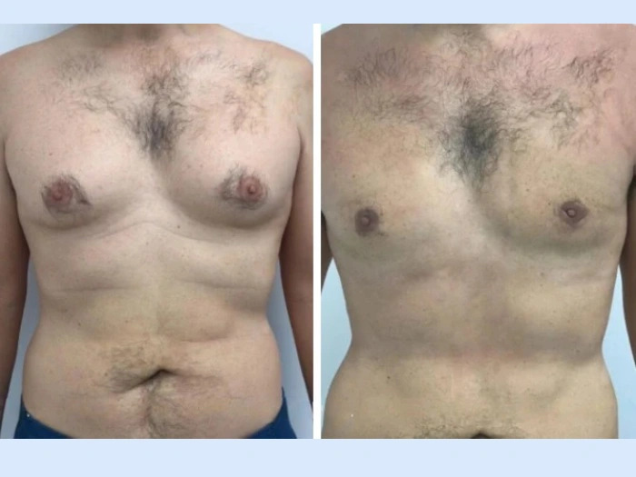 u3181-H4-Gynecomastia