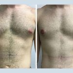 u3181-H7-Gynecomastia