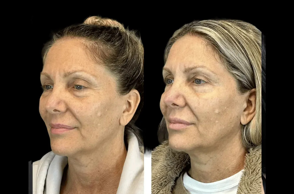 u3186-H9-Botox-1