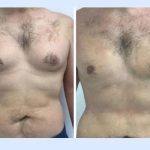 u3306-gynecomastia-in-dubai