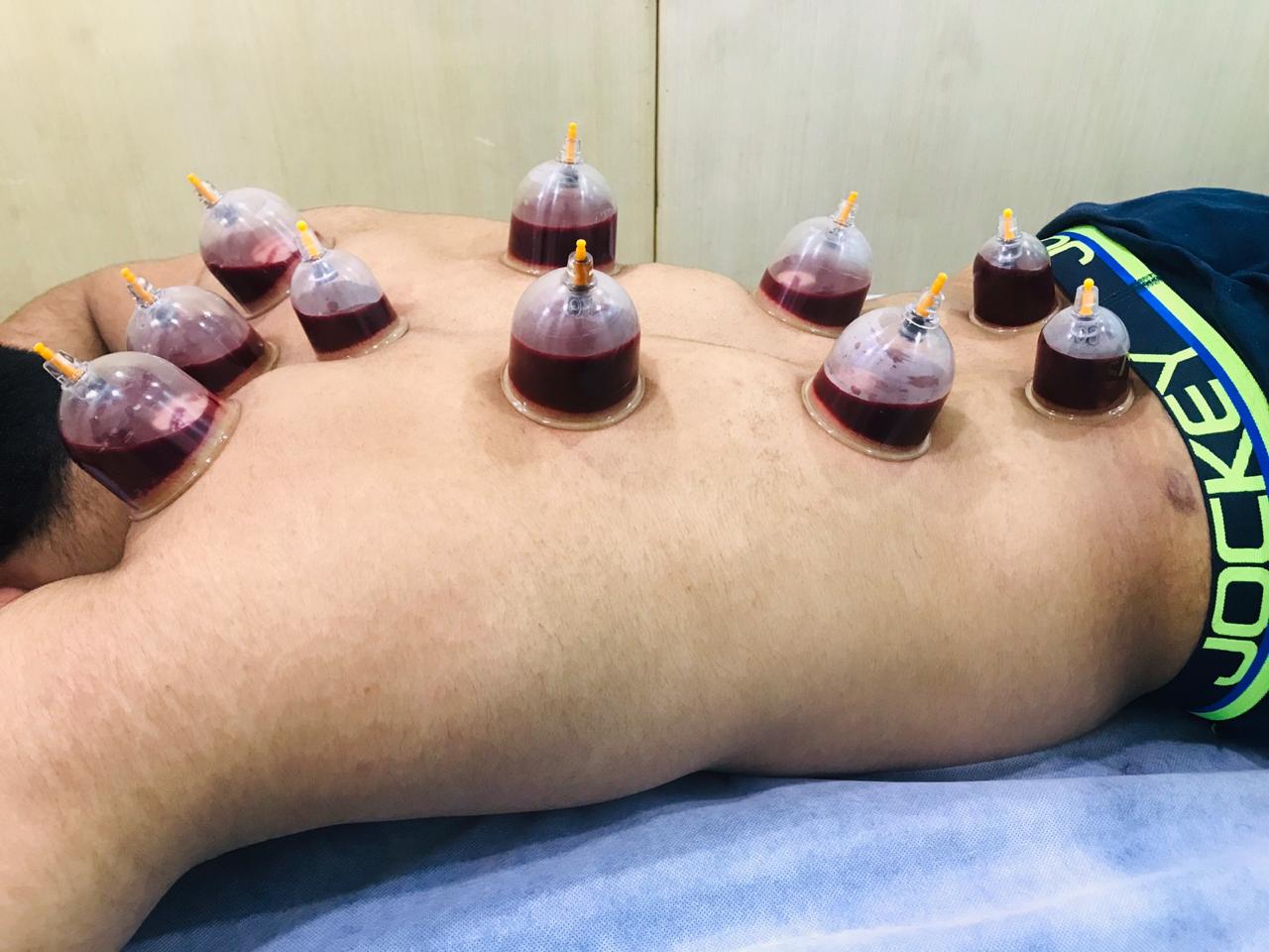 u3337-Hijama-Cupping-Therapy-in-Dubai7
