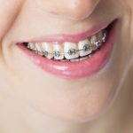 u3337-Teeth-Braces-Costs-in-Dubai1