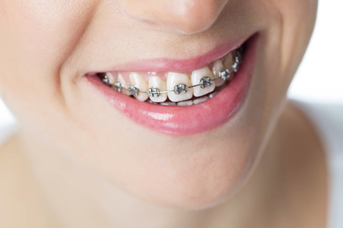 u3337-Teeth-Braces-Costs-in-Dubai1