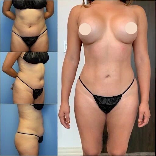 u3662-Liposuction-pictures