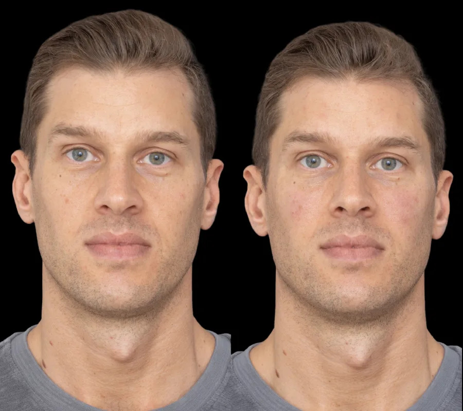 u3669-H2-Under-eye-fillers-gallery