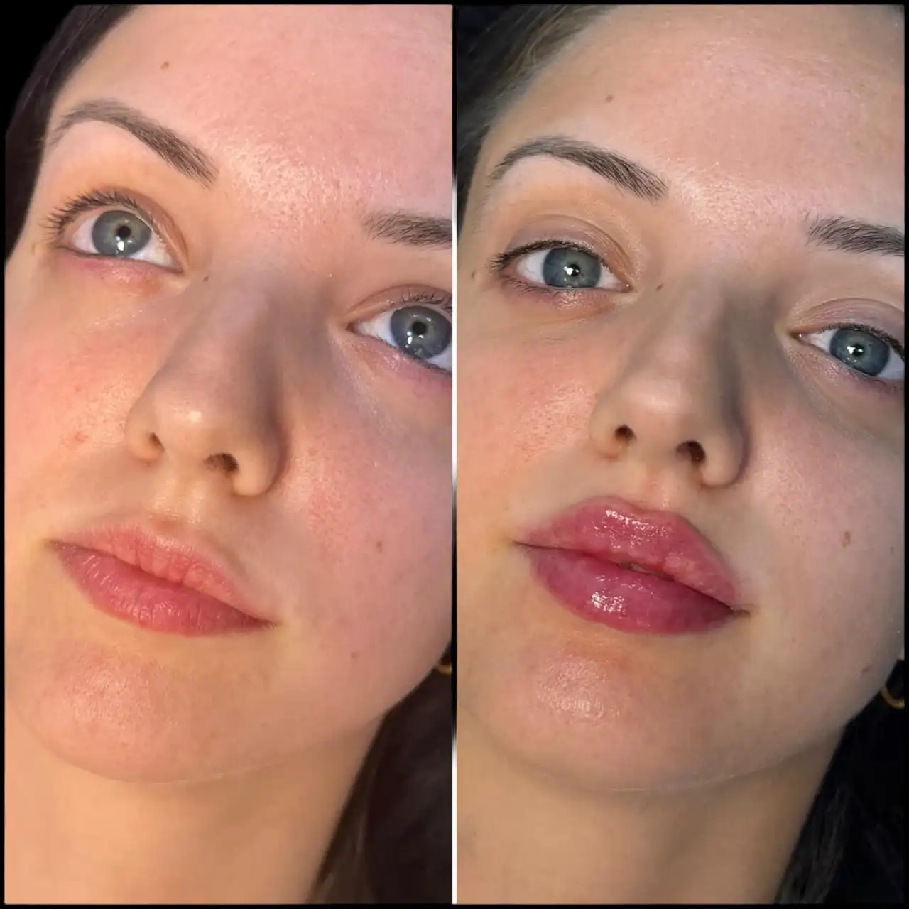 u3669-H5-lip-fillers-Fillers-in-Dubai-1