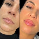 u3669-H6-lip-fillers
