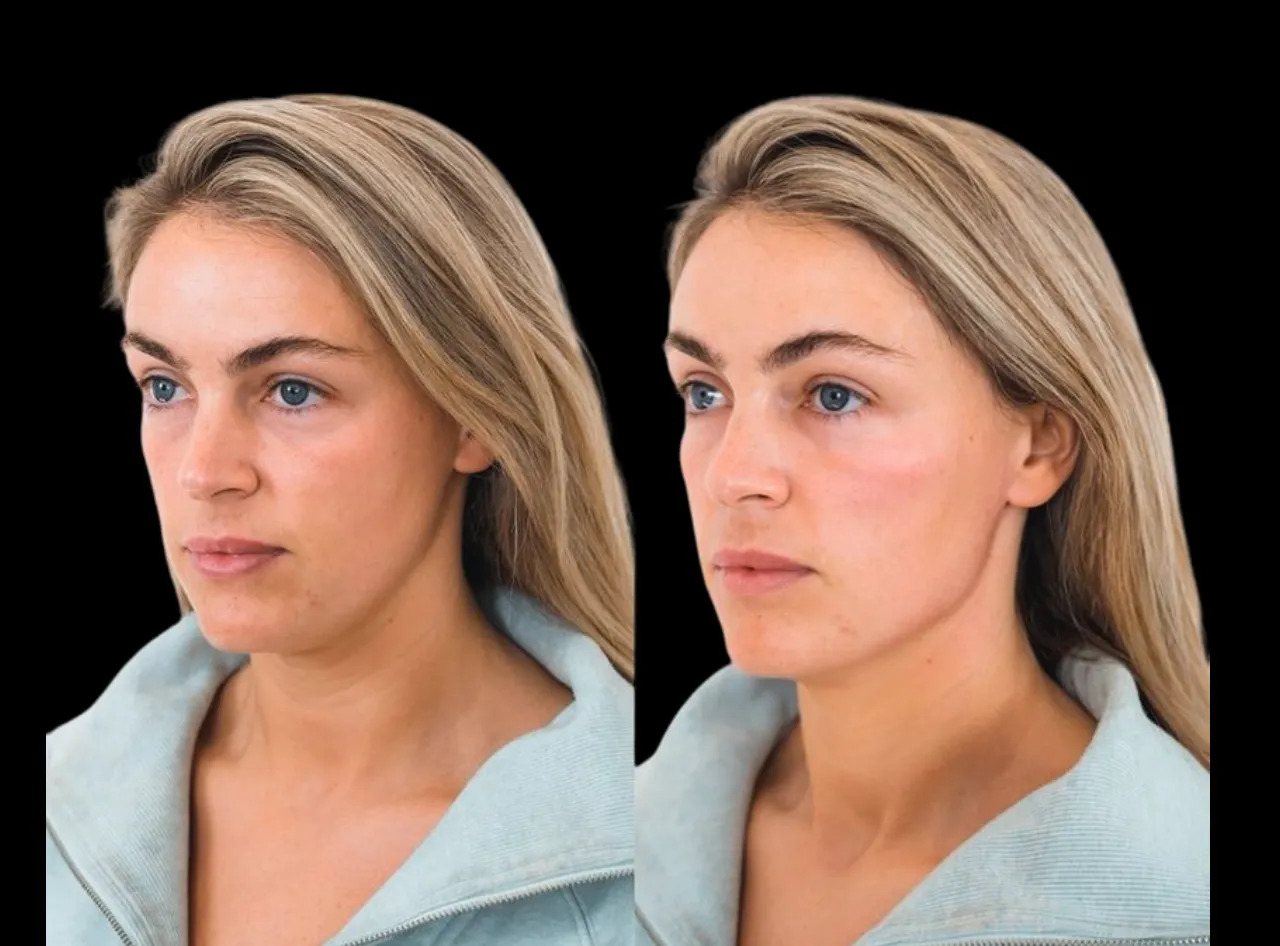 u3669-H7-Cheek-Fillers-images