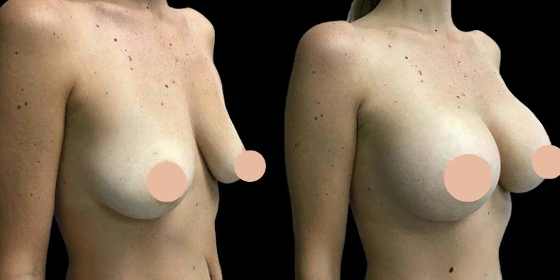 u4643-H11-Breast-Augmentation-ezgif.com-webp-to-jpg-converter