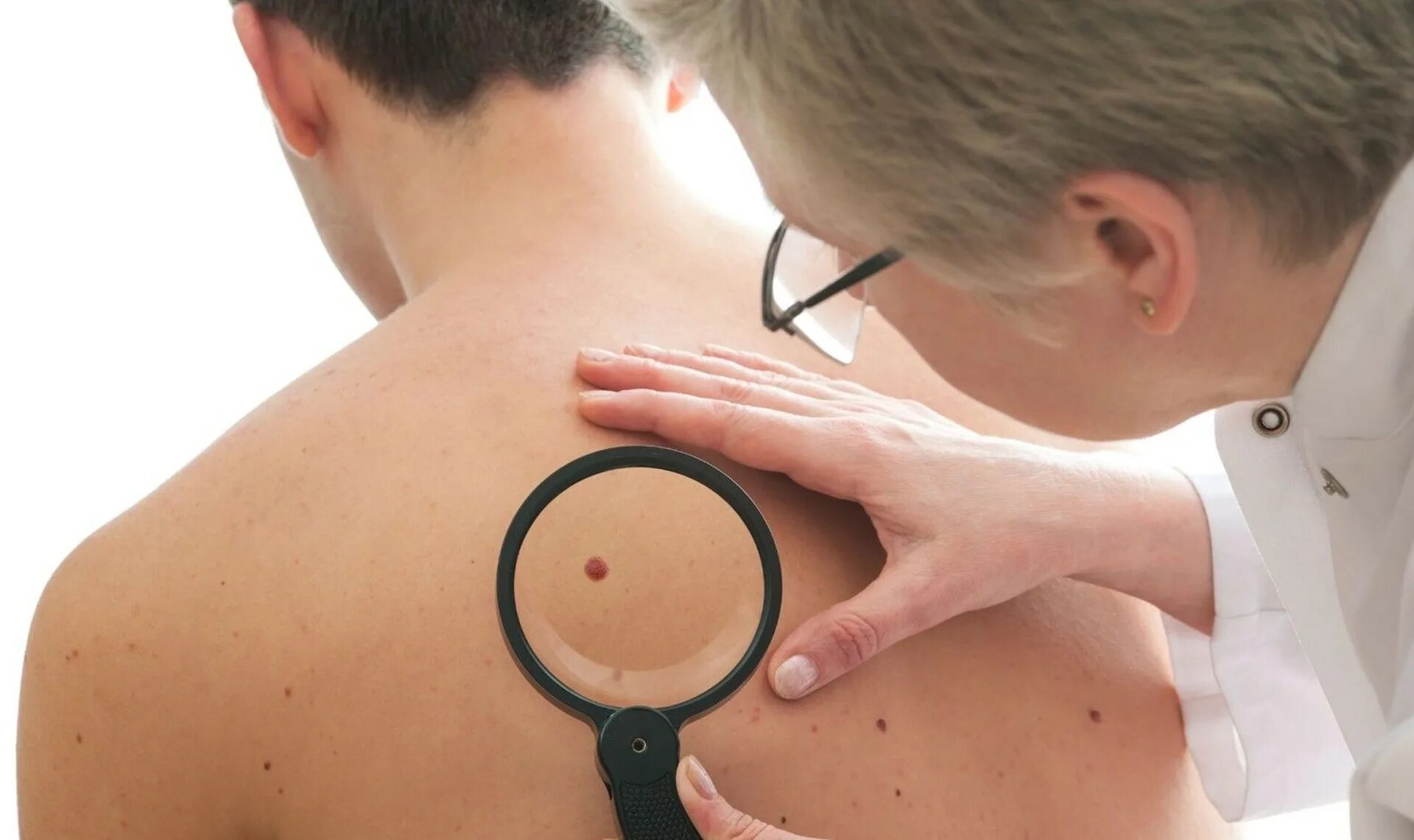 Moles Removal in Dubai