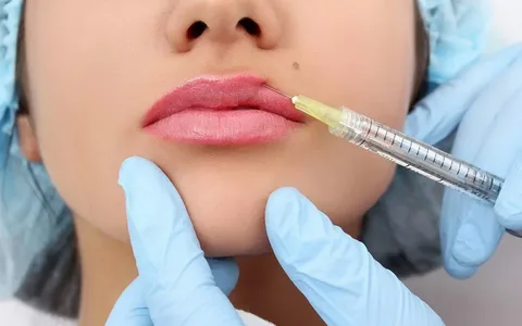 Dermal Fillers in Dubai