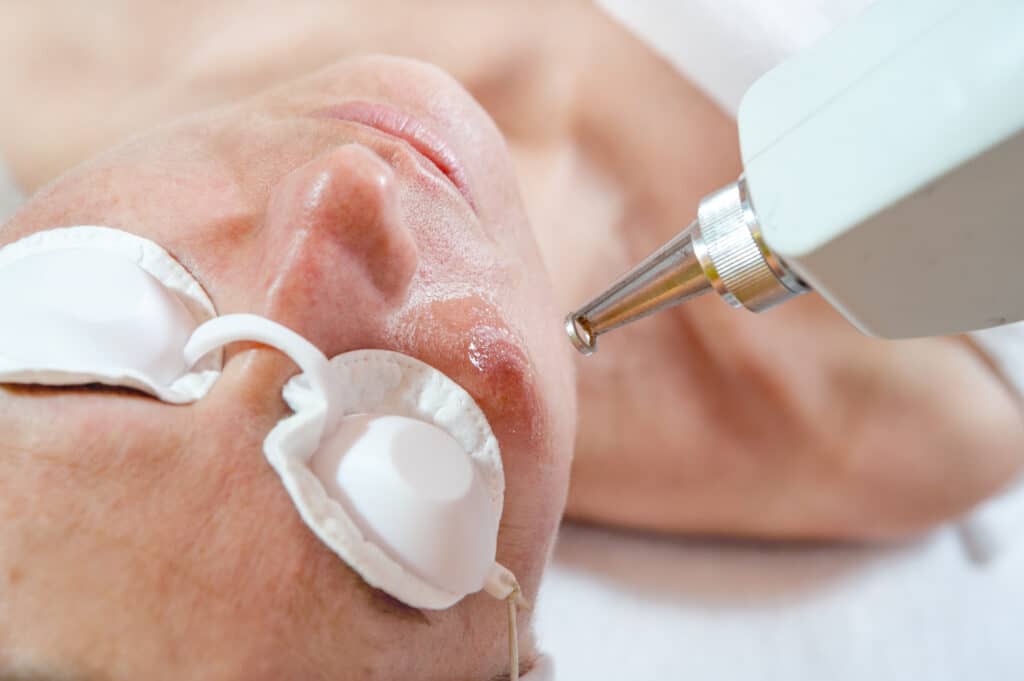 Picosure Laser Treatment Dubai