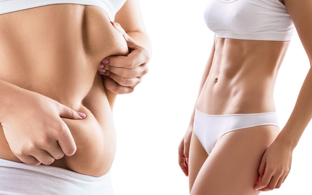 Tummy Tuck in Dubai