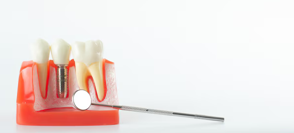 u7977-dental-implants-corbin