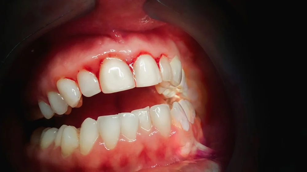 Deficiency-Causes-Bleeding-Gums