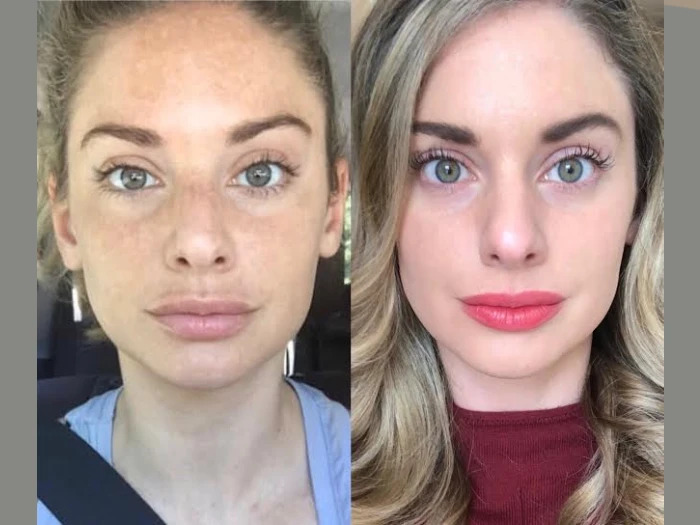 Radiofrequency (RF) Microneedling clinic in dubai