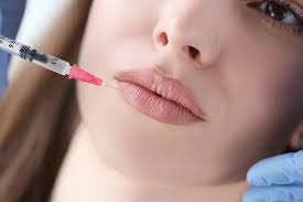 u8967-Russian-Lip-Fillers-2